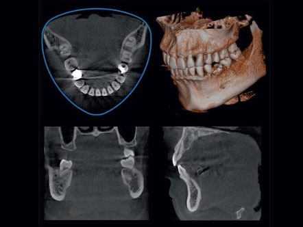 CBCT 3D imaging