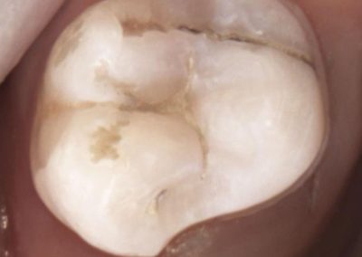 New abutment preparation with new design