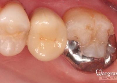 New bridge arrangement cemented