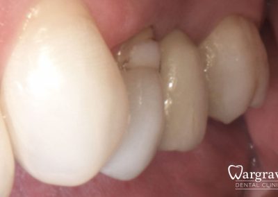 New Bridge buccal view