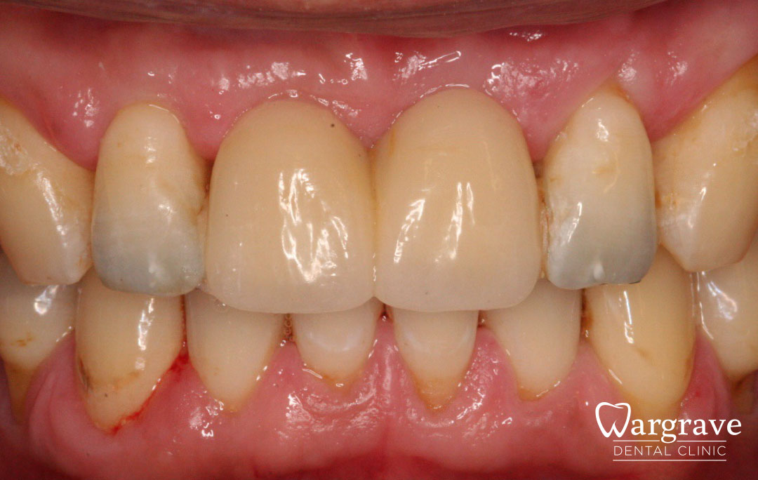 Adhesive Bridge solution for missing central incisors after