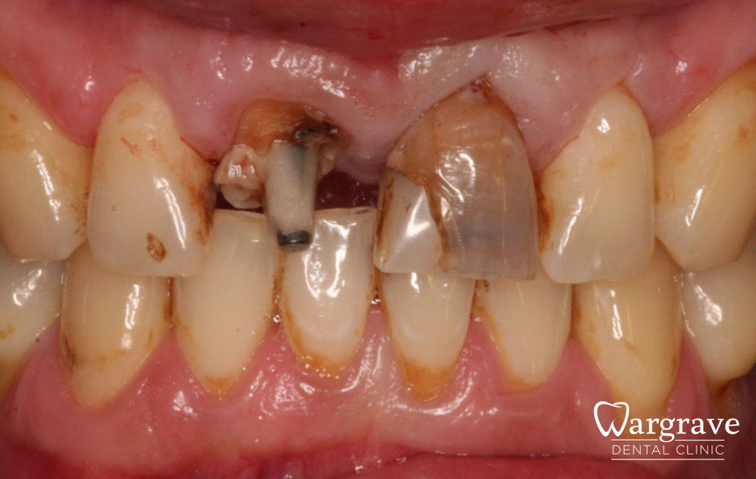 Adhesive Bridge solution for missing central incisors before
