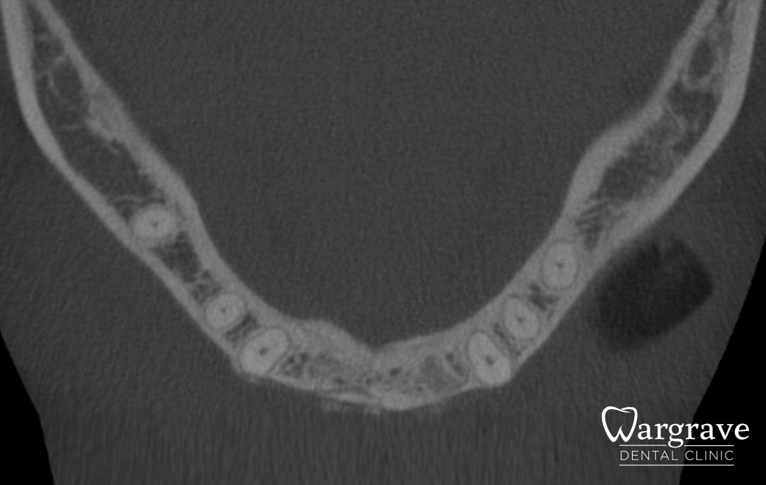 Anterior Mandible Bone Regeneration after