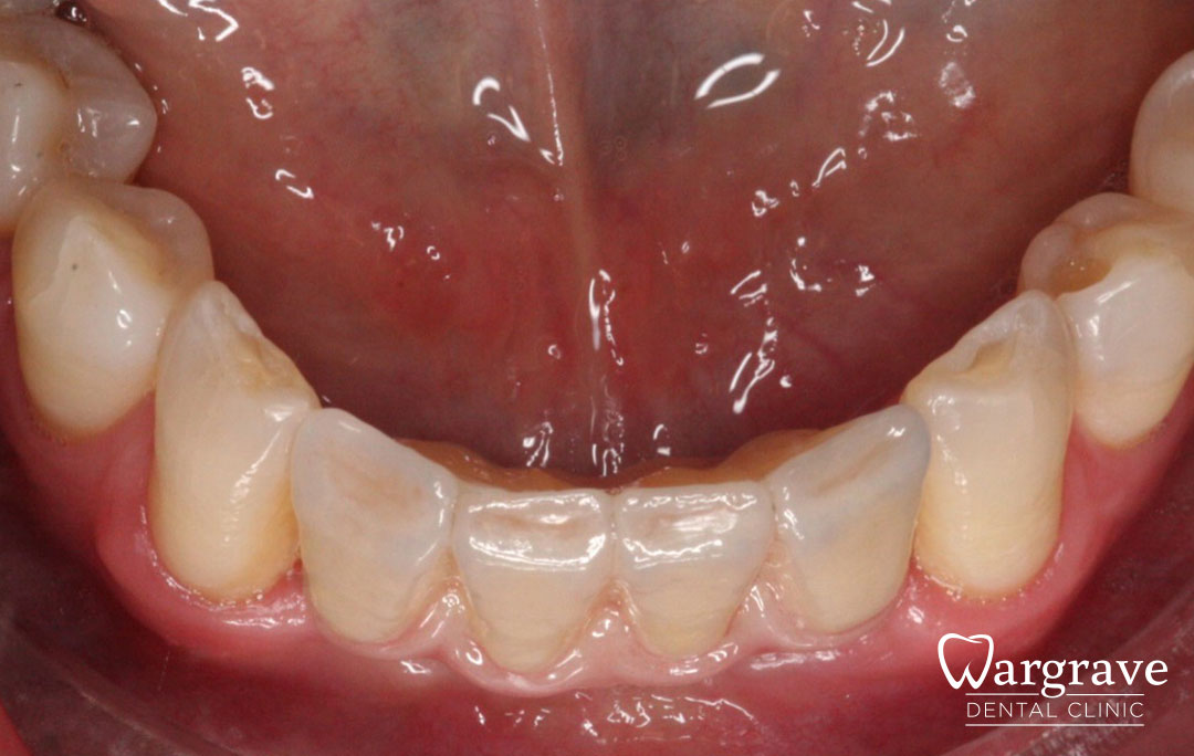 Anterior Mandible Bone Regeneration after