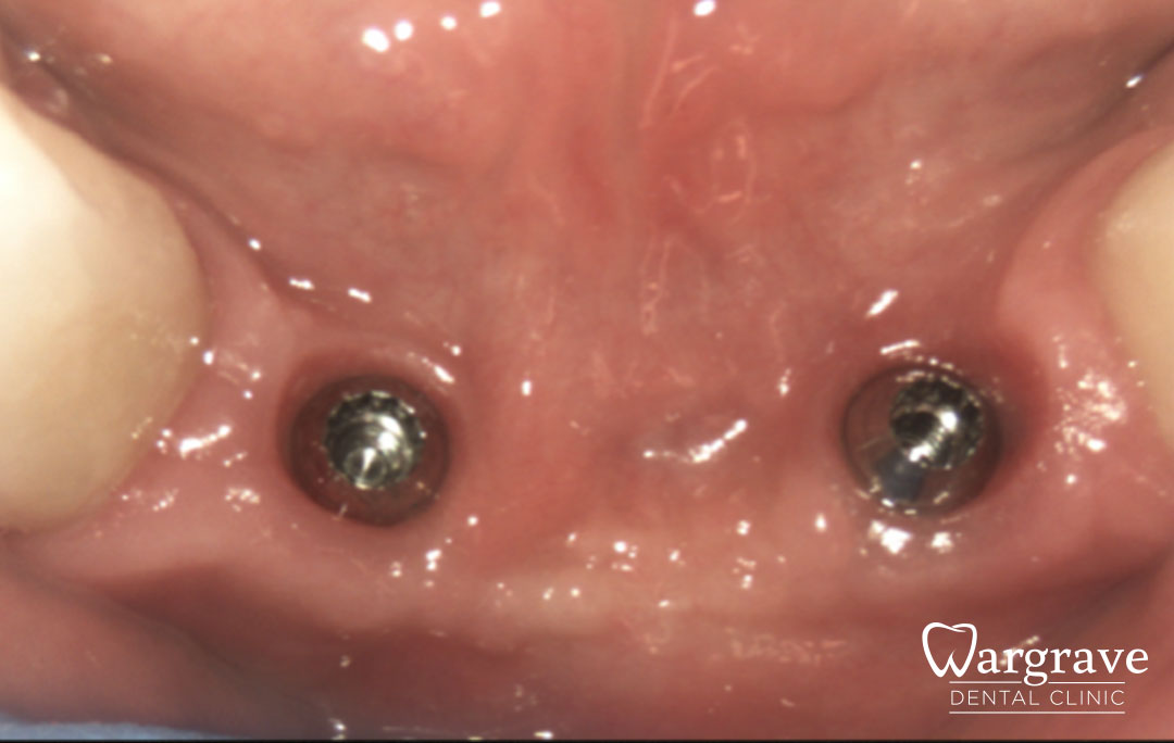 Anterior Mandible Bone Regeneration