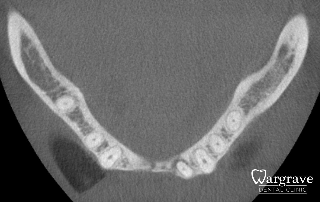 Anterior Mandible Bone Regeneration before
