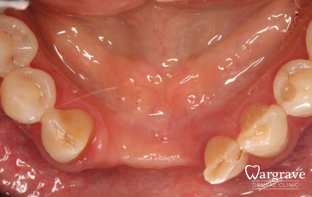 Anterior Mandible Bone Regeneration  before