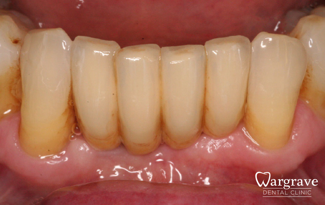 Anterior Mandibular Implant Bridge after
