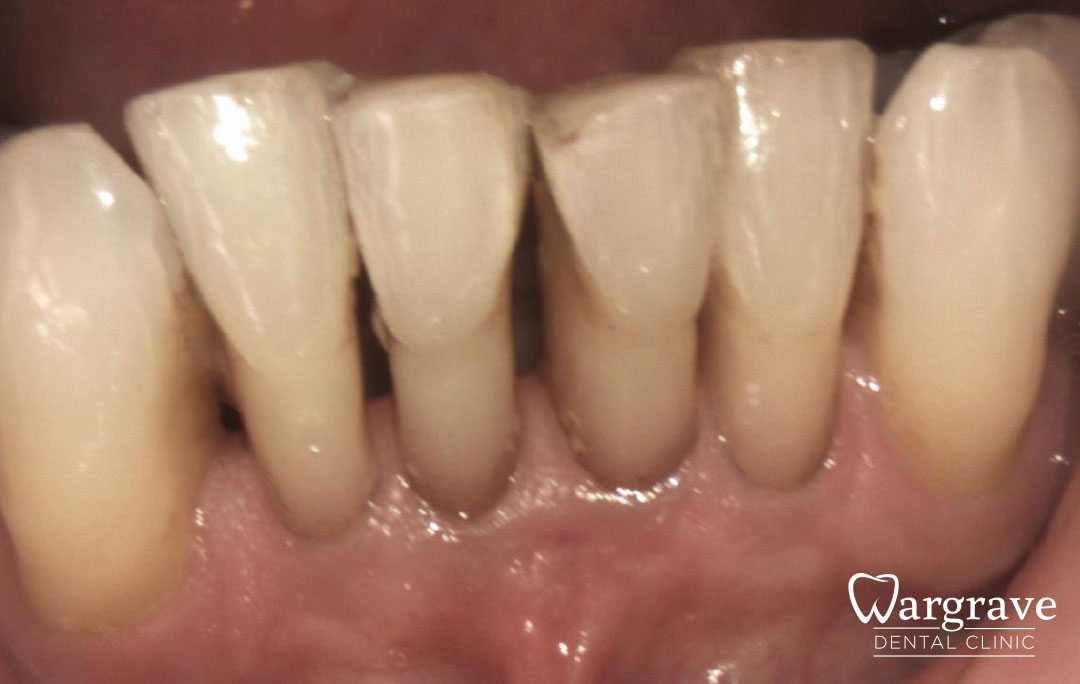 Anterior Mandibular Implant Bridge before