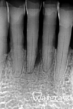 Anterior Mandibular Implant Bridge