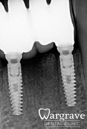 Anterior Mandibular Implant Bridge