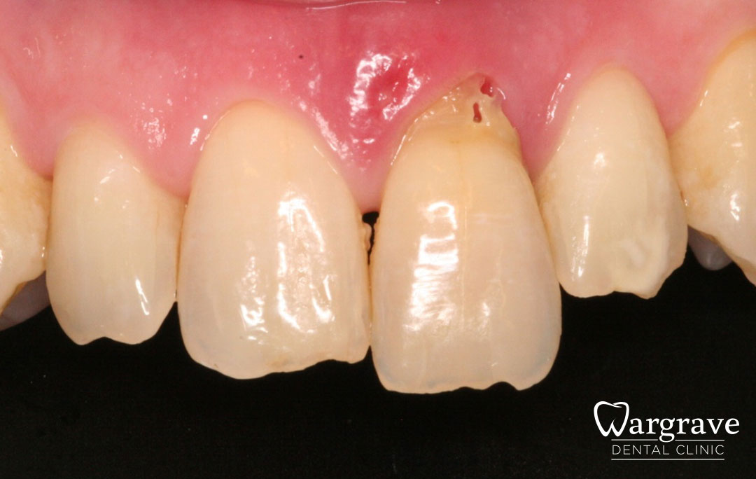 Immediate Implant before