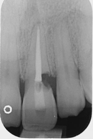 Immediate Implant xray