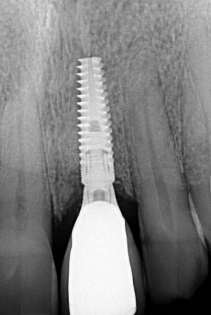 Immediate Implant xray