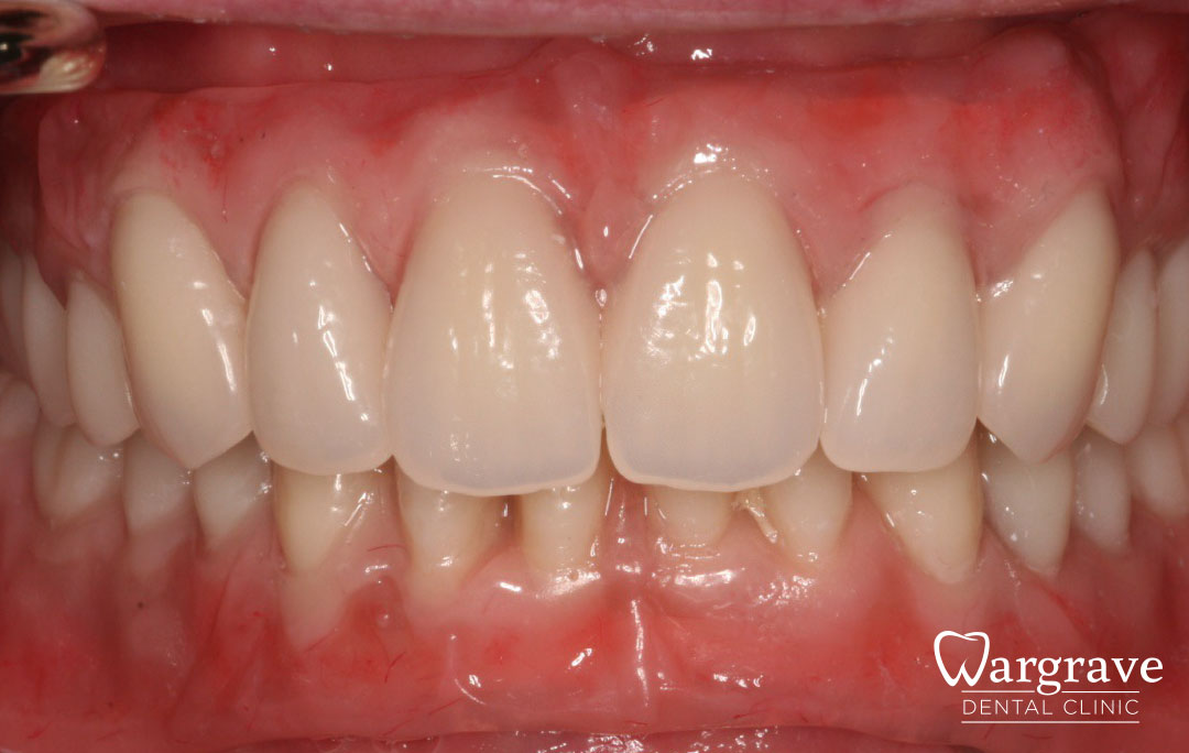 Implant stabilised ‘Life Like’ replacement dentures after