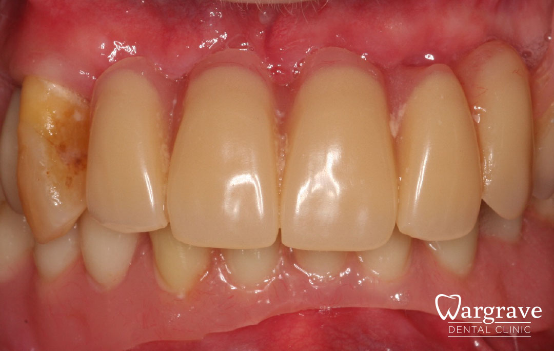 Implant stabilised ‘Life Like’ replacement dentures before