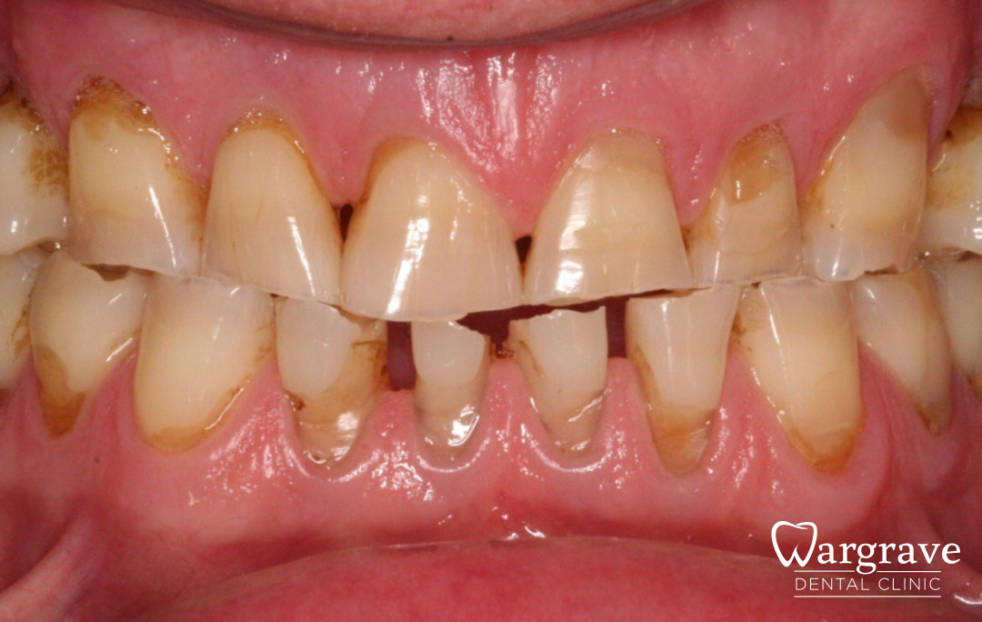 Injection Moulding using Composite Resin before