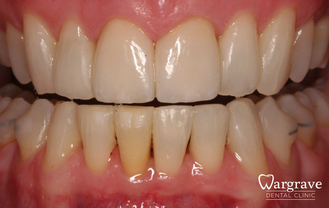 Multidisciplinary care Orthodontics, Replacement veneers and composite bonding after