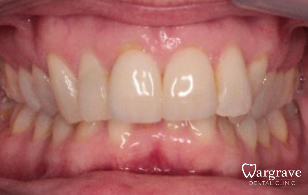 Multidisciplinary care including Orthodontics Replacement veneers and composite bonding 
