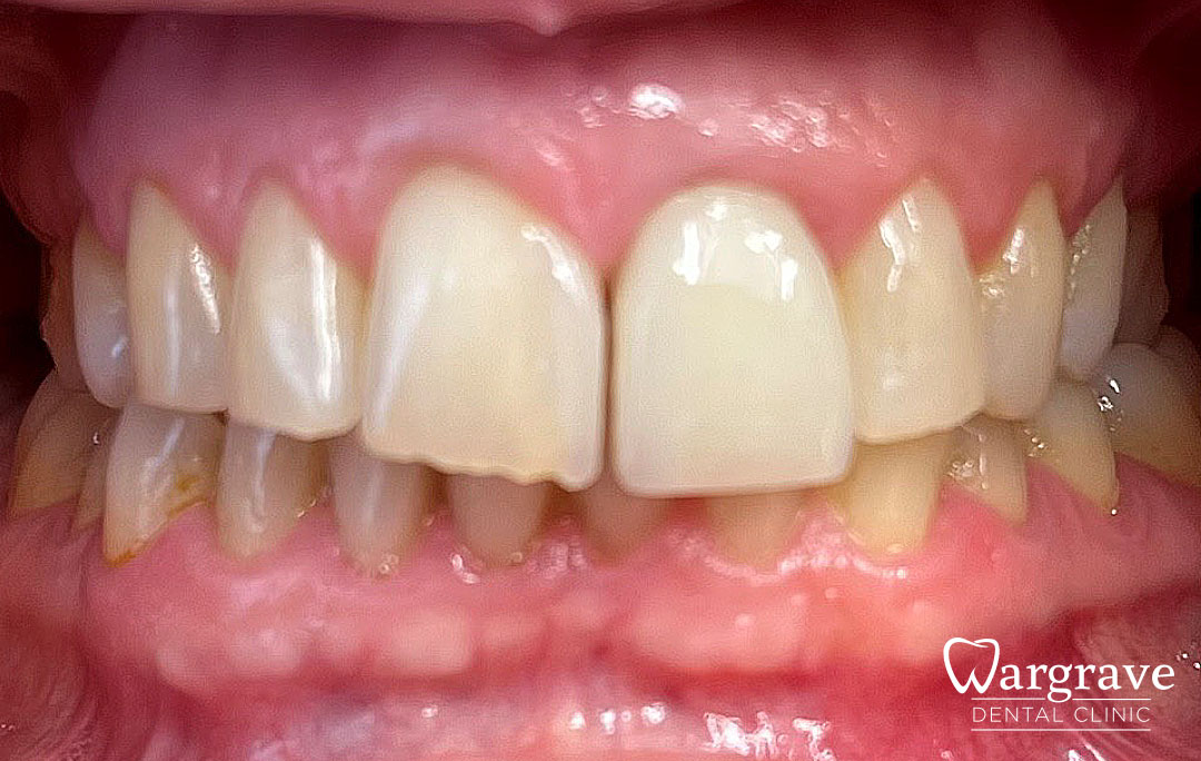 Replacement crown, Veneer and Composite Bonding before