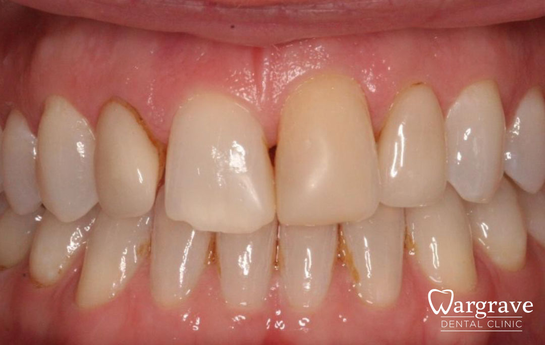 Replacement Crowns and Veneer before