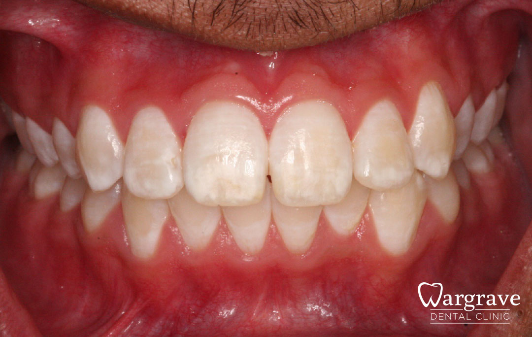 tooth whitening after
