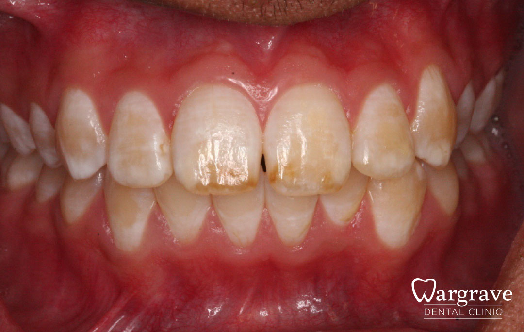 tooth whitening before